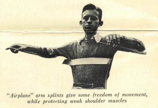 A boy stands with arms extended using splints.