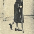 A woman walks using cructhes.