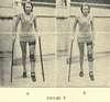 Two photographs of a woman walking with two canes and a leg brace.