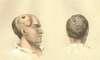 Two images of a man who had a musket ball pass through his head.