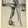 A child in braces stands using crutches.