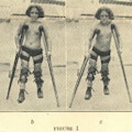 Four photographs of a child walking with crutches and braces.