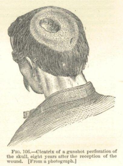 An engraving of the back of a man's head with a large cavity.